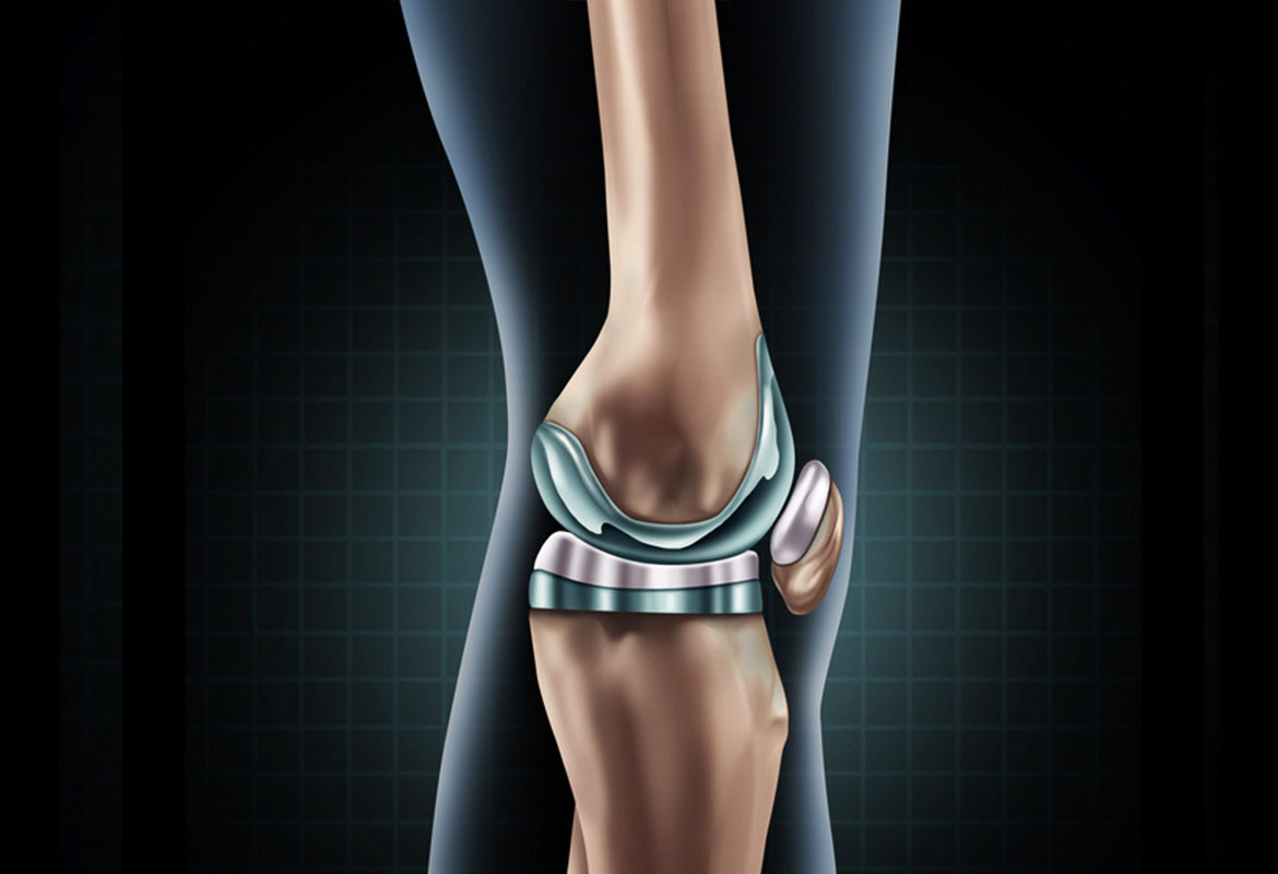 pose de prothèse du genou par un très bon spécialiste de la chirurgie du genou à paris