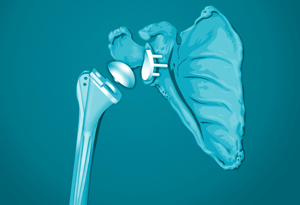 l'arthrose et les prothèses - IOAPC Paris 8 - chirurgie de l'épaule par le chirurgien de l'épaule C. Charousset