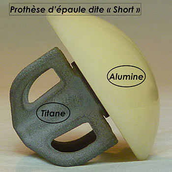 pose de prothèse de l'épaule en titane et alumine par très bon un chirurgien orthopédiste à Paris 8