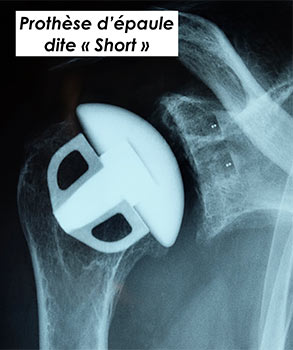 pose de prothèse d'épaule dite Short par très bon un chirurgien orthopédiste à Paris 8