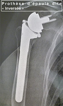 pose de prothèse d'épaule dite inversée par très bon un chirurgien orthopédiste à Paris 8