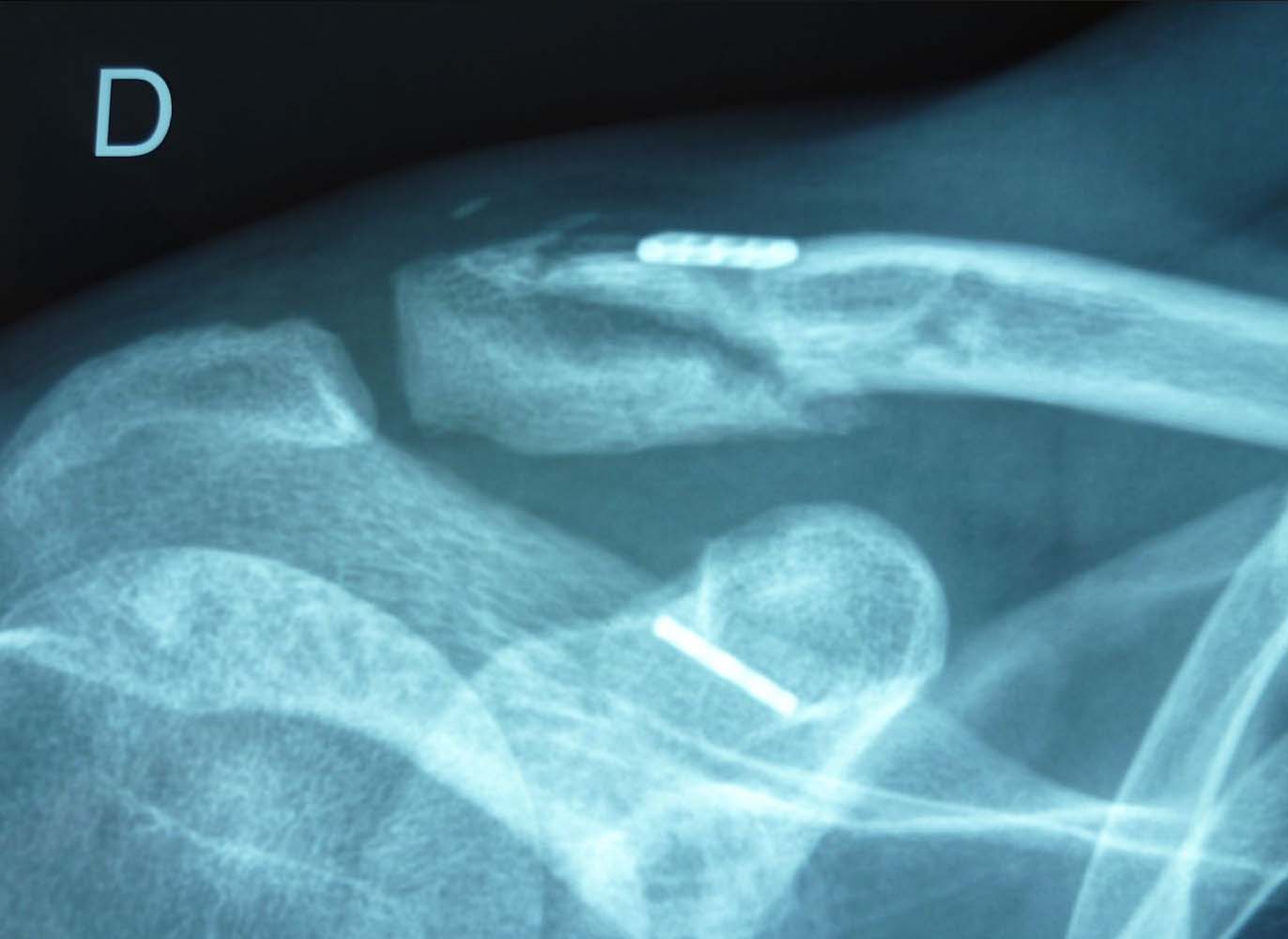 Ostéosynthèse Fracture du 1/4 moyen de la clavicule fractures de l'épaule traumatisme chirurgie par le docteure Christophe Charousset IOAPC Paris