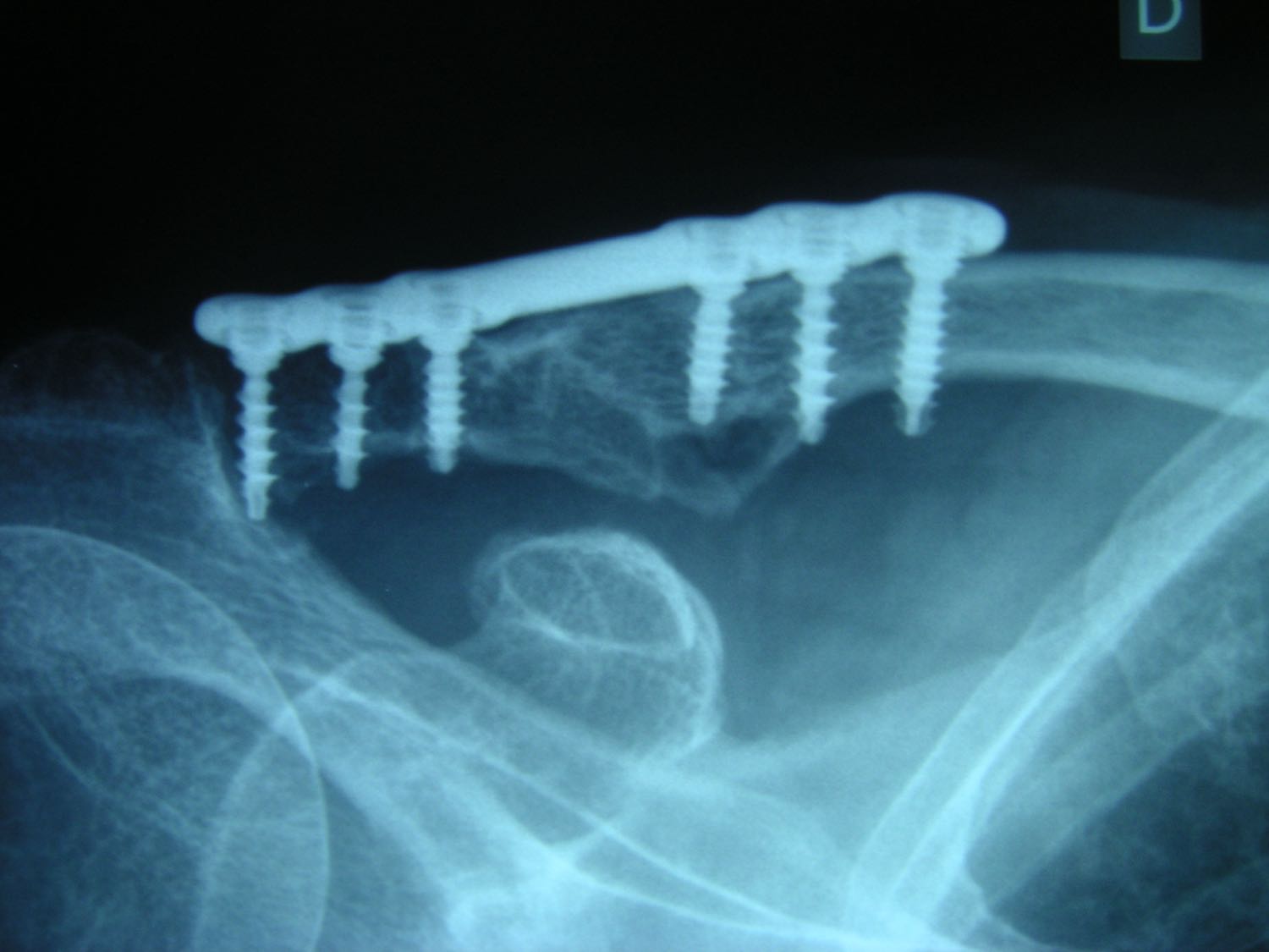 Ostéosynthèse Fracture du 1/3 moyen de la clavicule fractures de l'épaule traumatisme chirurgie par le docteure Christophe Charousset IOAPC Paris