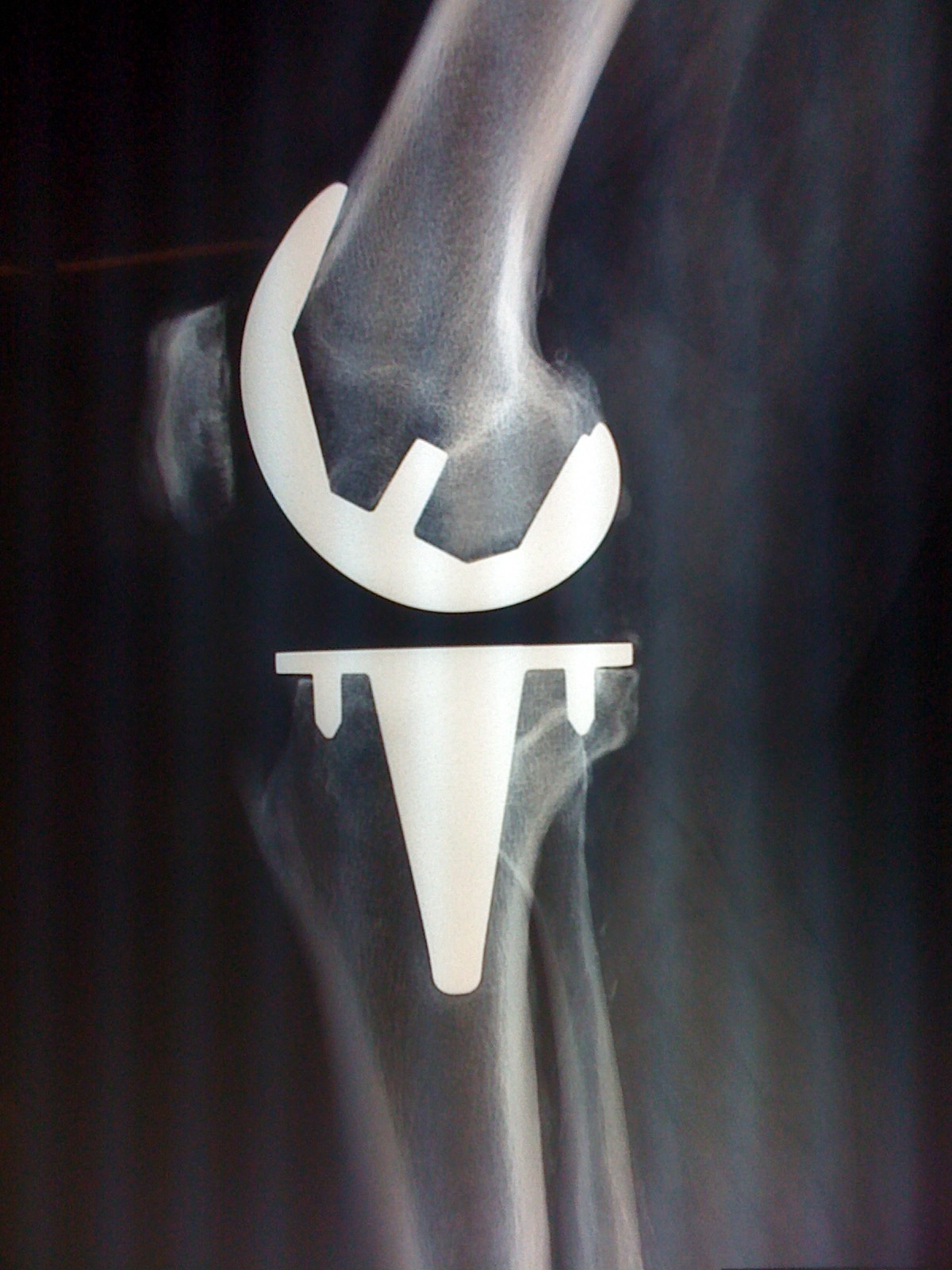 traitement de l'arthrose et pose de prothèse de l'épaule, prothèse du genou par un très bon chirurgien orthopédiste à paris 8