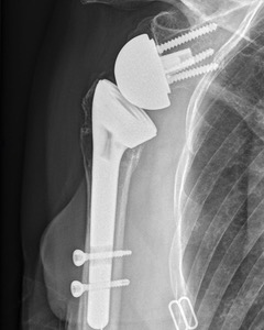 Ostéosynthèse d'une fracture de l'épaule par une prothèse totatle d'épaule inversée fractures de l'épaule traumatisme chirurgie par le docteure Christophe Charousset IOAPC Paris