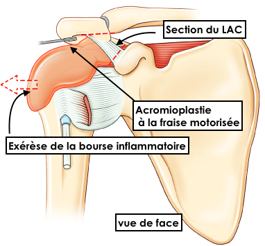 tendinite de la coiffe des rotateurs Acromioplastie de l'épaule assistée par arthroscopie par le docteur Christophe Charousset IOAPC Paris