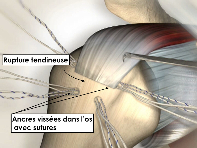 RUPTURE DES TENDONS DE LA COiffe des rotateurs Réparation de la coiffe des rotateurs sous arthroscopie par le docteur Christophe Charousset IOAPC Paris