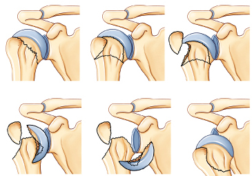  fractures de l'épaule traumatisme chirurgie par le docteure Christophe Charousset IOAPC Paris