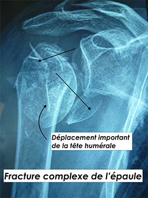  fractures de l'épaule traumatisme chirurgie par le docteure Christophe Charousset IOAPC Paris