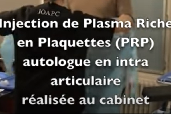 injection PRP en intra articulaire du genou par le Dr Charousset