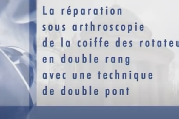 Réparation sous arthroscopie d'une rupture de coiffe des rotateurs de l'épaule par le Dr Charousset